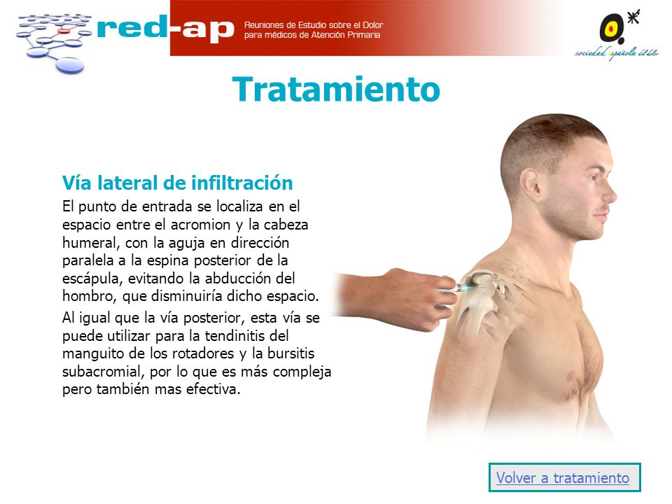 bursitis de hombro consecuencias